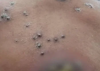 छत्तीसगढ़ में मिला क्यूटेनियस नोकार्डिया का पहला केस, स्वास्थ्य विभाग में मचा हड़कंप..