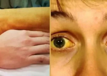 छत्तीसगढ़ के इस जिले में पीलिया का प्रकोप… 30 से ज्यादा लोग आए चपेट में, दो की हालत गंभीर