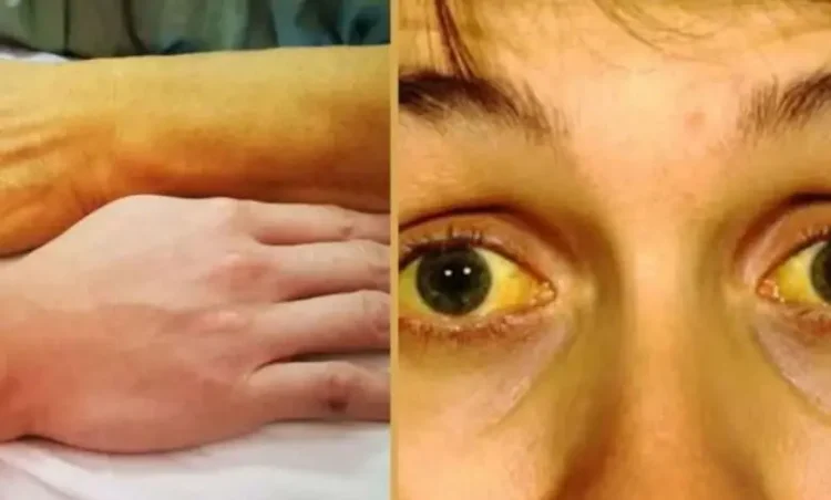 छत्तीसगढ़ के इस जिले में पीलिया का प्रकोप… 30 से ज्यादा लोग आए चपेट में, दो की हालत गंभीर