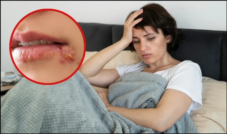 बुखार के बाद होंठों पर दाने क्यों? जानिए कारण, लक्षण और बचाव के आसान उपाय